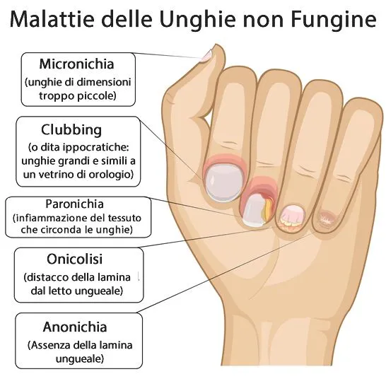 Malattie delle Unghie quali sono e come riconoscerle dai sintomi